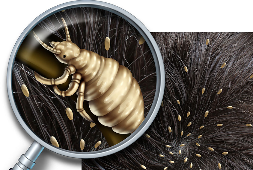 уничтожения вшей